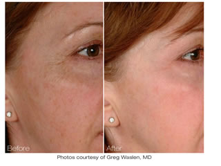 pore reduction skin rejuvenation Morristown new jersey