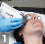 fraxel treatment nyc manhattan