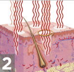 fraxel treatment nyc manhattan