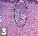 fraxel treatment nyc manhattan