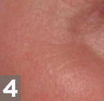 fraxel treatment nyc manhattan