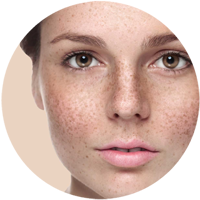 post care instructions for ipl