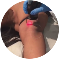 post care instructions for laser hair removal