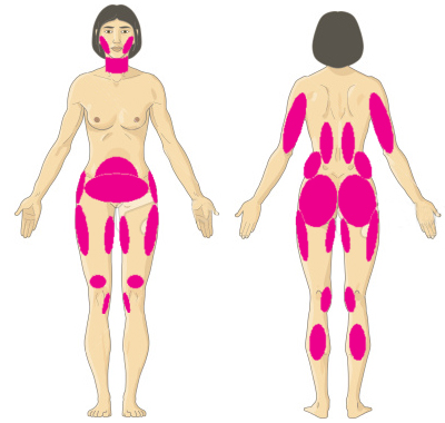 smartlipo body areas White Plains 10601