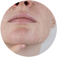 post care instructions for vi peel