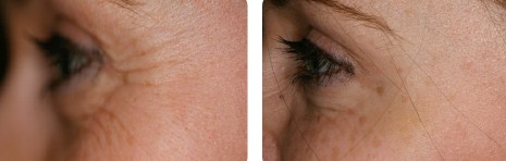 Botox crows feet White Plains Westchester